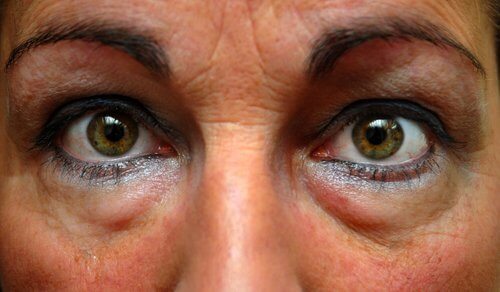 bags-eyes