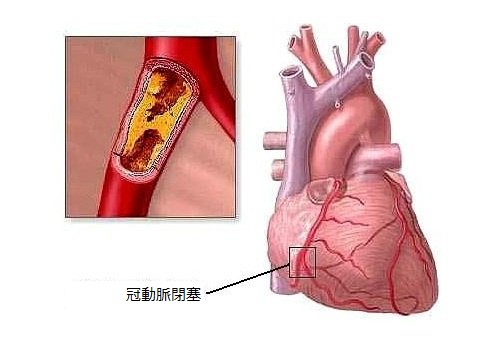 心疾患を引き起こす8つの生活習慣 心疾患を引き起こす8つの生活習慣