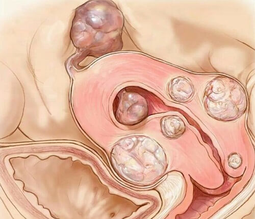 fibroid