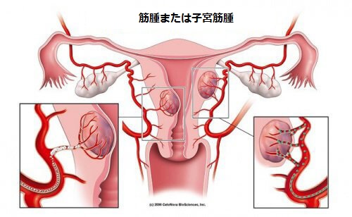 子宮筋腫:知っておきたい5つの事実