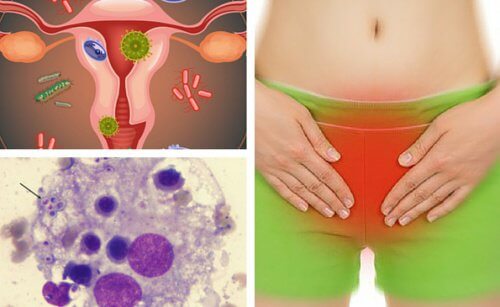 膣感染症を緩和する6つの方法 膣感染症を緩和する6つの方法