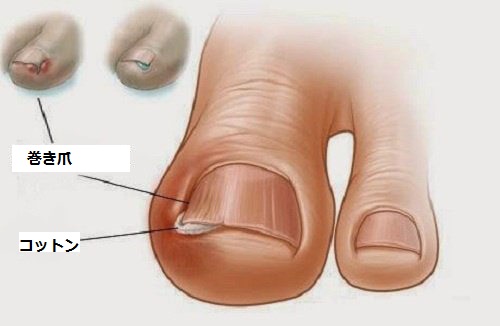 足の巻き爪に効く6つの方法