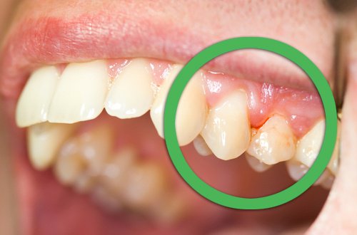 gingivitis-500x330