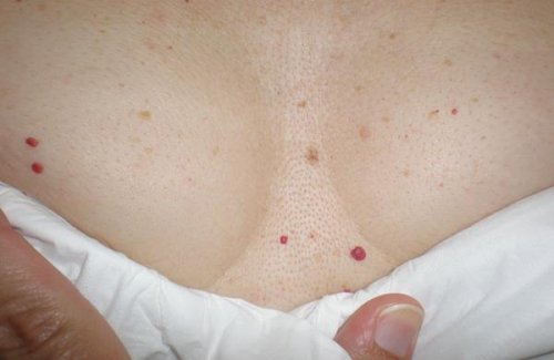 皮膚にできる赤い斑点：心配するべき？