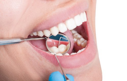 reduces-cavities-500x318