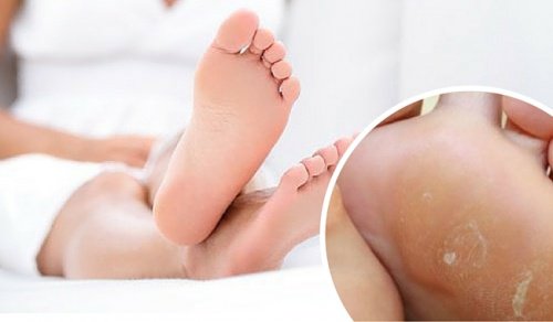 足からタコを取り除く家庭療法