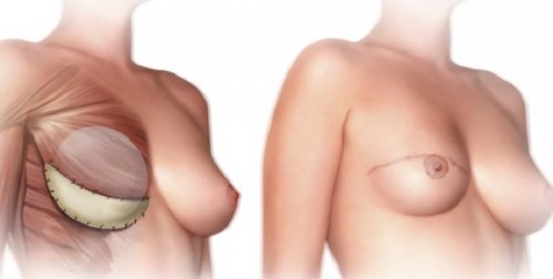 乳房切除術の前に知っておくべきこと3選 乳房切除術の前に知っておくべきこと3選