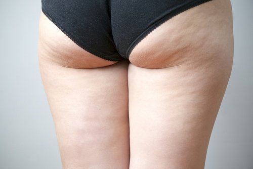 2-cellulite