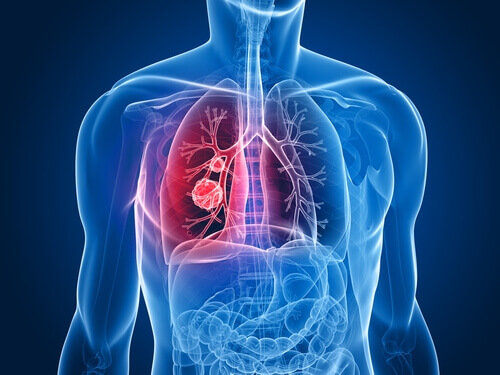 2-lung-cancer
