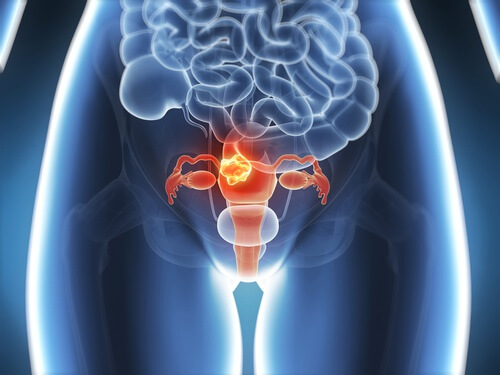 知っておくべき子宮頸がんの６つの症状