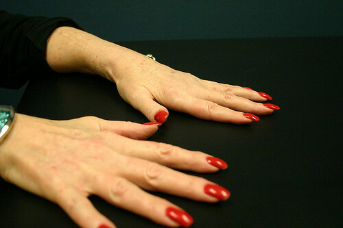 arthritis-2