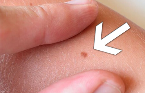 moles