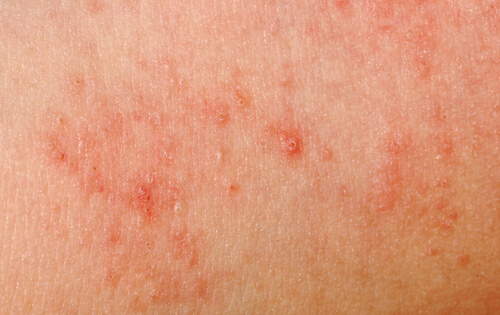 skin-allergies