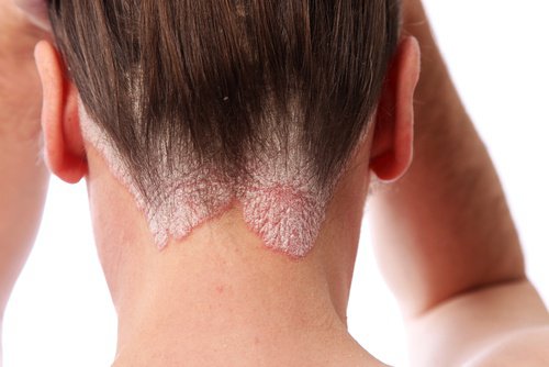 que-saber-sobre-la-psoriasis-500x334