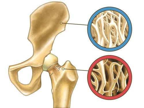 loss-of-bone-mass