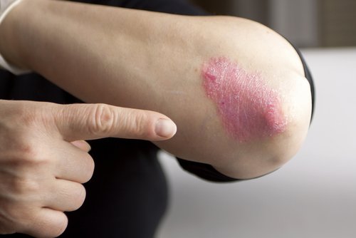 psoriasis-placa-500x334