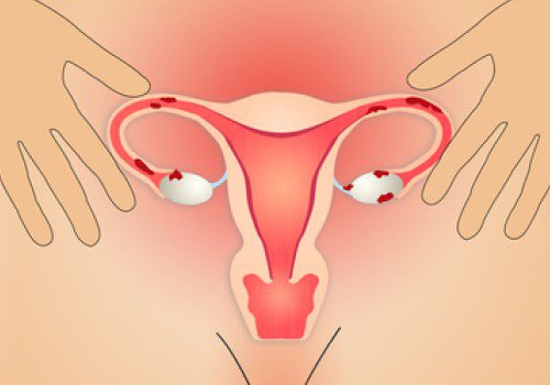 子宮内膜症に効果的な生活改善法