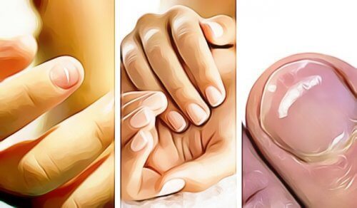 爪からわかる病気のサイン５選