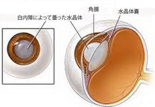 白内障と水晶体