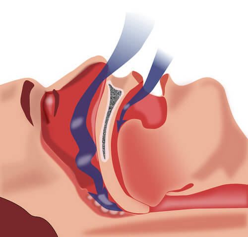 睡眠時一時的無呼吸症候群の治療法 睡眠時一時的無呼吸症候群の治療法