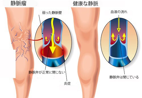 静脈瘤に効果的なエクササイズ 静脈瘤に効果的なエクササイズ