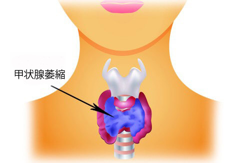甲状腺機能低下症