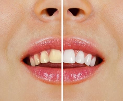 自然のもので歯を白くする方法
