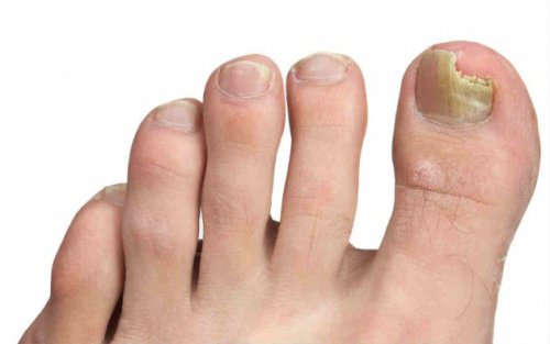 foot with nail fungus