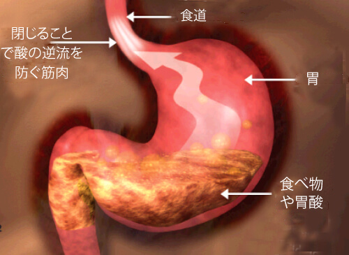 胃食道逆流症の人にオススメの食生活