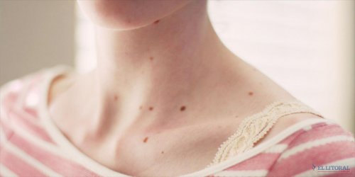 皮膚がん予防に効果のあるハーブたち