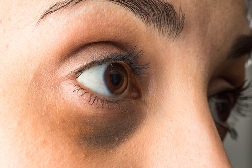 目袋の原因とその改善法