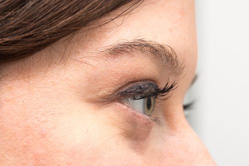 目の下のふくらみ、目袋の原因とその改善法