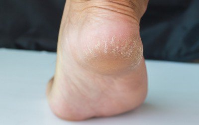 かかとの乾燥とひび割れを治す6つの方法 かかとの乾燥とひび割れを治す6つの方法