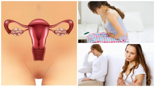 PCOS(多嚢胞性卵巣症候群)について知っておくべき 7 つの事