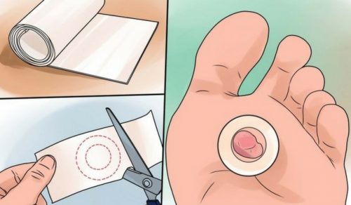水ぶくれを治す9つの方法