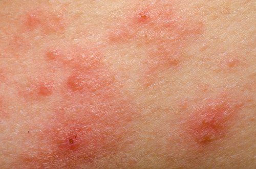 ロザケアの9つの自然療法
