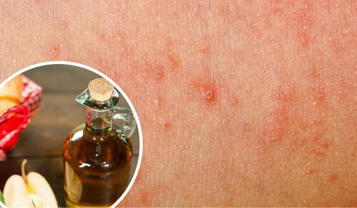 真菌感染症を家庭で治療する方法