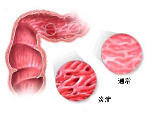 過敏性腸症候群の症状を緩和するアドバイス