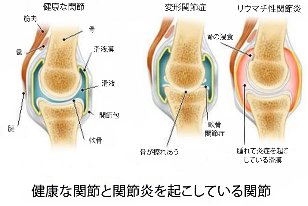 関節炎、変形関節症、骨粗しょう症の違い 関節炎、変形関節症、骨粗しょう症の違い