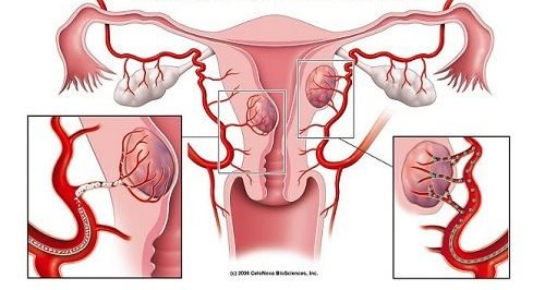 子宮筋腫の警告サイン７つ