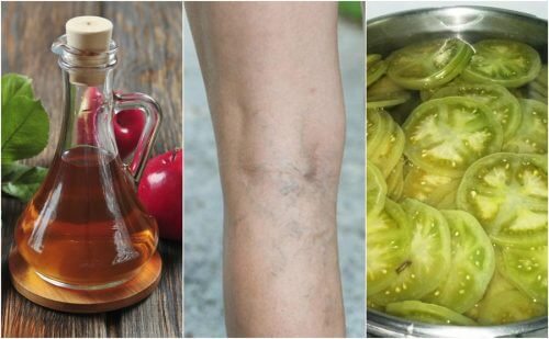 静脈瘤に効くお酢とグリーントマトを使った家庭療法