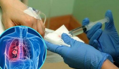肺がん患者が受ける化学療法の副作用を緩和する薬が発見 肺がん患者が受ける化学療法の副作用を緩和する薬が発見