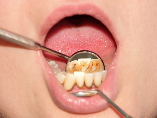 自然に歯石を取る方法