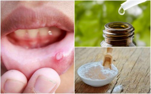 口内炎の症状を緩和する６つの自然療法