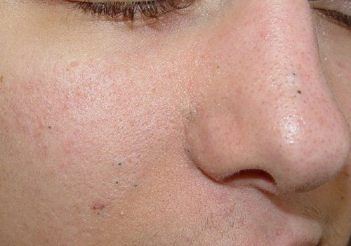 小鼻の毛穴の黒ずみを取り除く自家製ピーリング3選