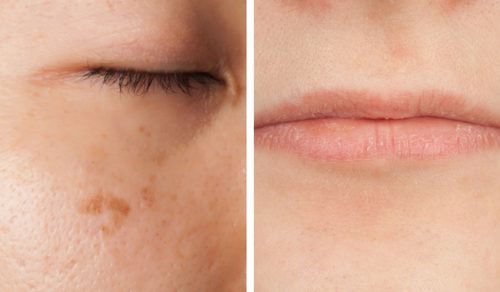 顔で分かるビタミン不足5つのサイン