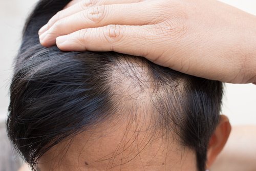 薄毛対策に効果的な自然療法6選 薄毛対策に効果的な自然療法6選