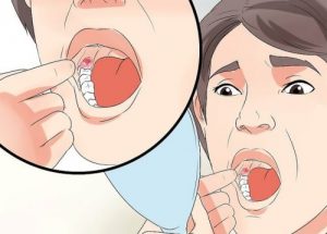 親知らずを抜いた後の腫れを抑える方法