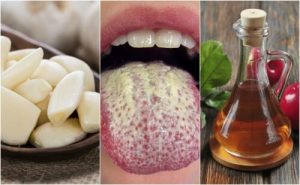 カンジダの増殖を抑える6つの自然療法