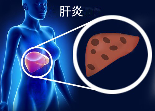 肝炎
